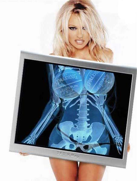 Voici le secret de l'oppulente poitrine de Pamela Anderson dévoilé au rayon X ! height=
